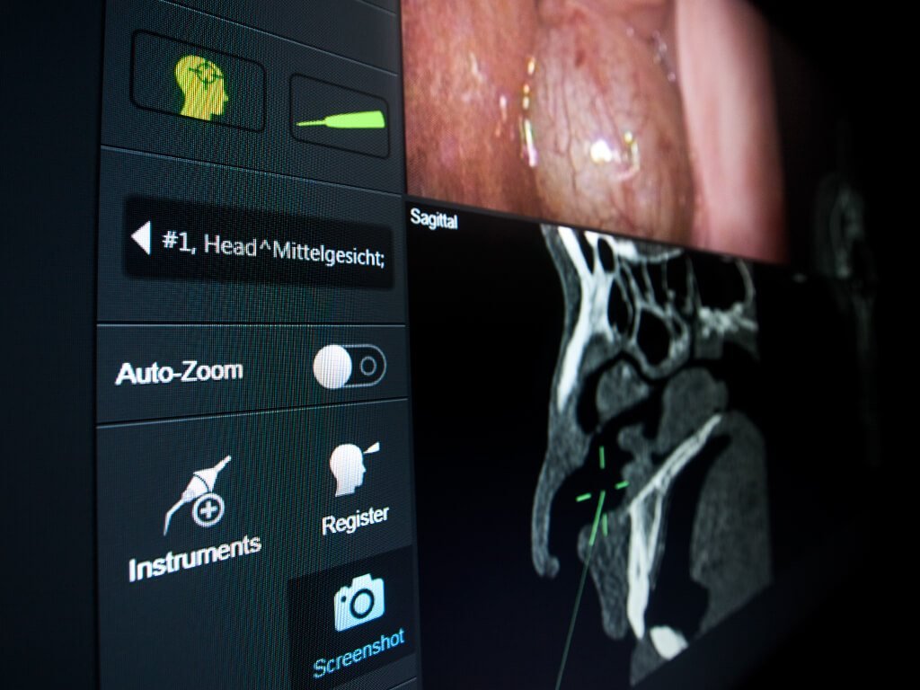 ENT navigation interface showing an endoscopic view beside a CT slice