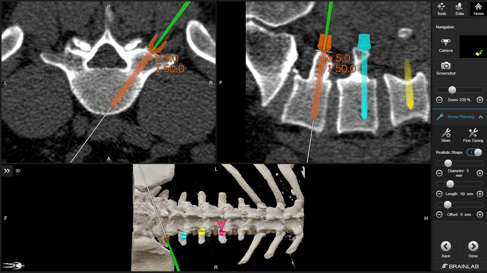 Pedicle screw trajectories shown on axial, sagittal and 3D spine navigation views