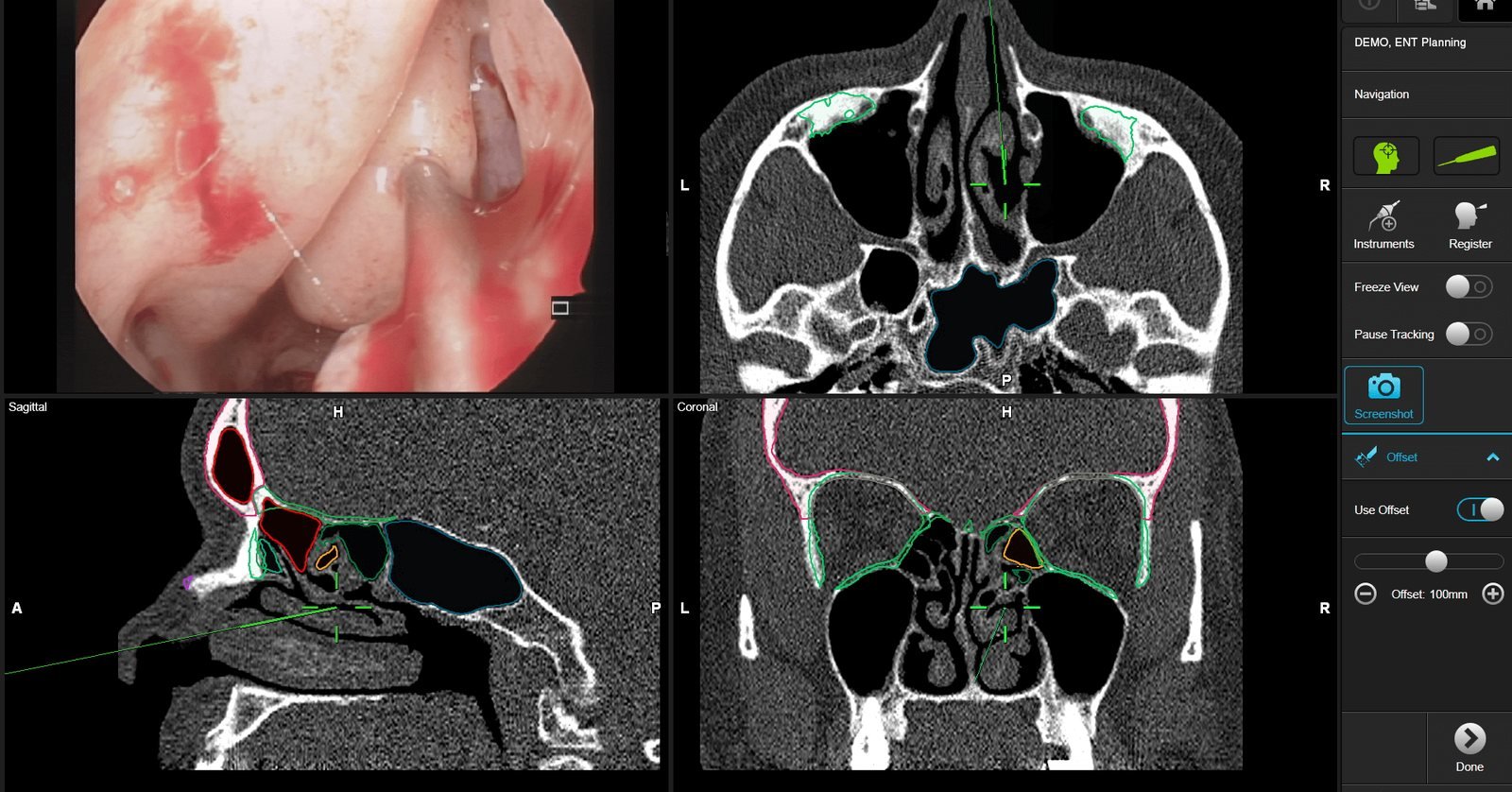 ENT navigation system for endoscopic sinus and skull base surgery