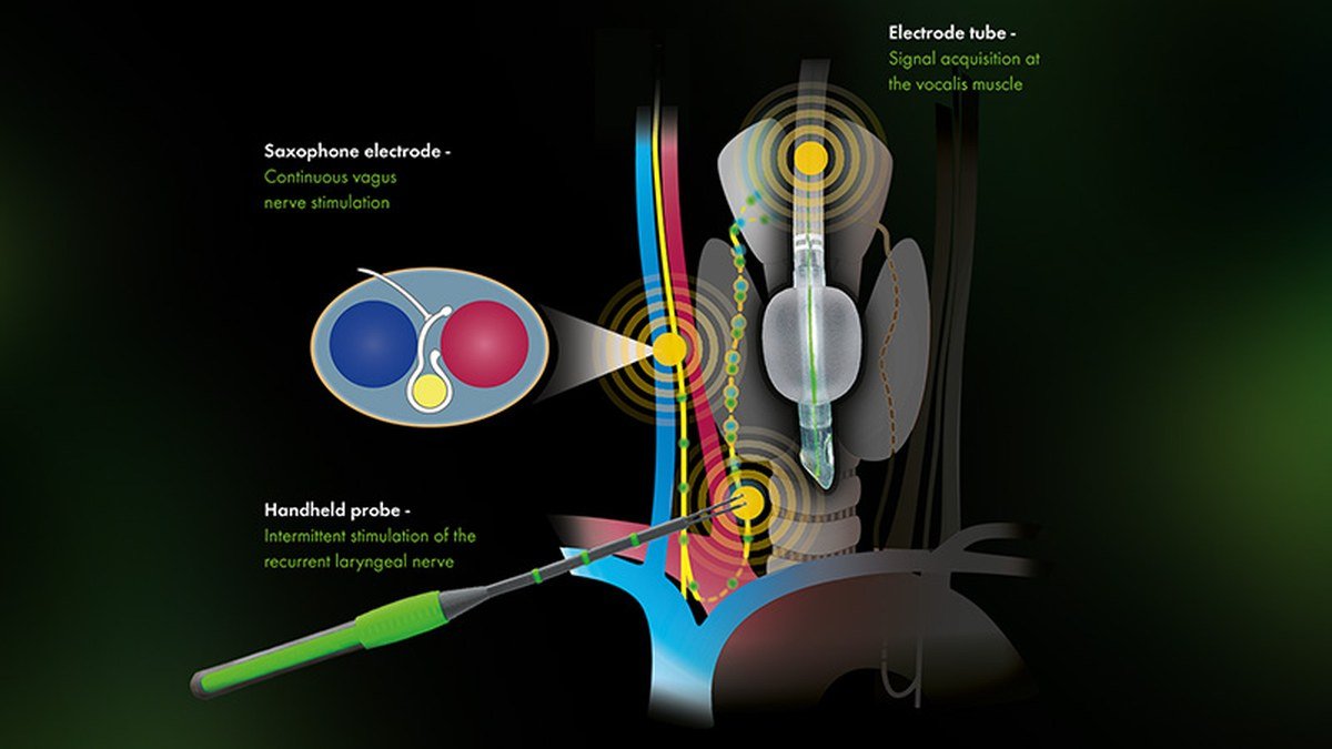 Continuous intraoperative neuromonitoring setup in thyroid surgery with saxophone vagus electrode, tube electrode and handheld probe